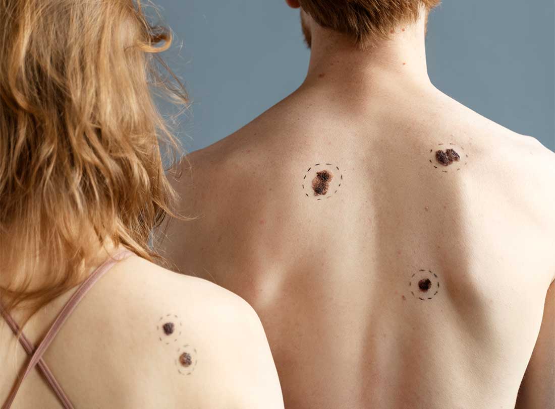Mappatura Nei: Guida completa all'uso del Videodermatoscopio Digitale