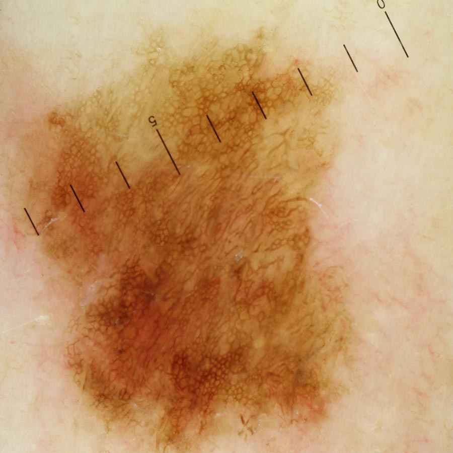 Videodermatoscopio DERMALview Laptop